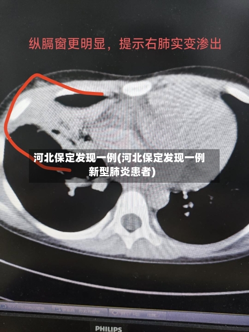 河北保定发现一例(河北保定发现一例新型肺炎患者)-第2张图片
