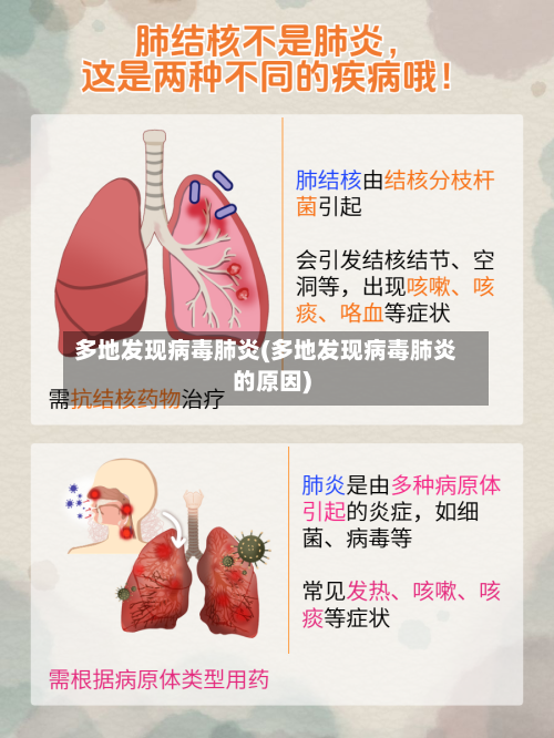 多地发现病毒肺炎(多地发现病毒肺炎的原因)-第2张图片